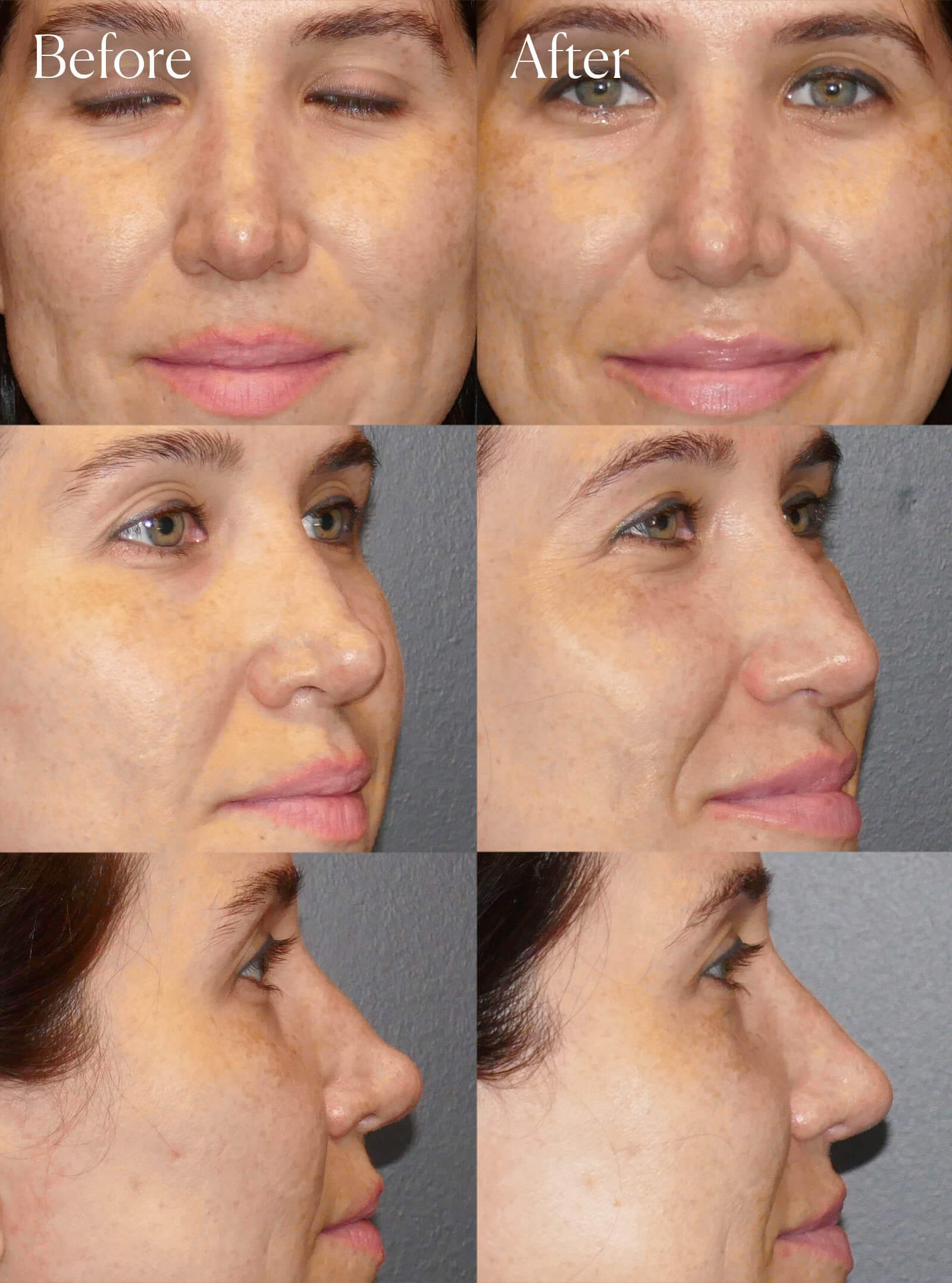 revision tip rhinoplasty procedure colorado