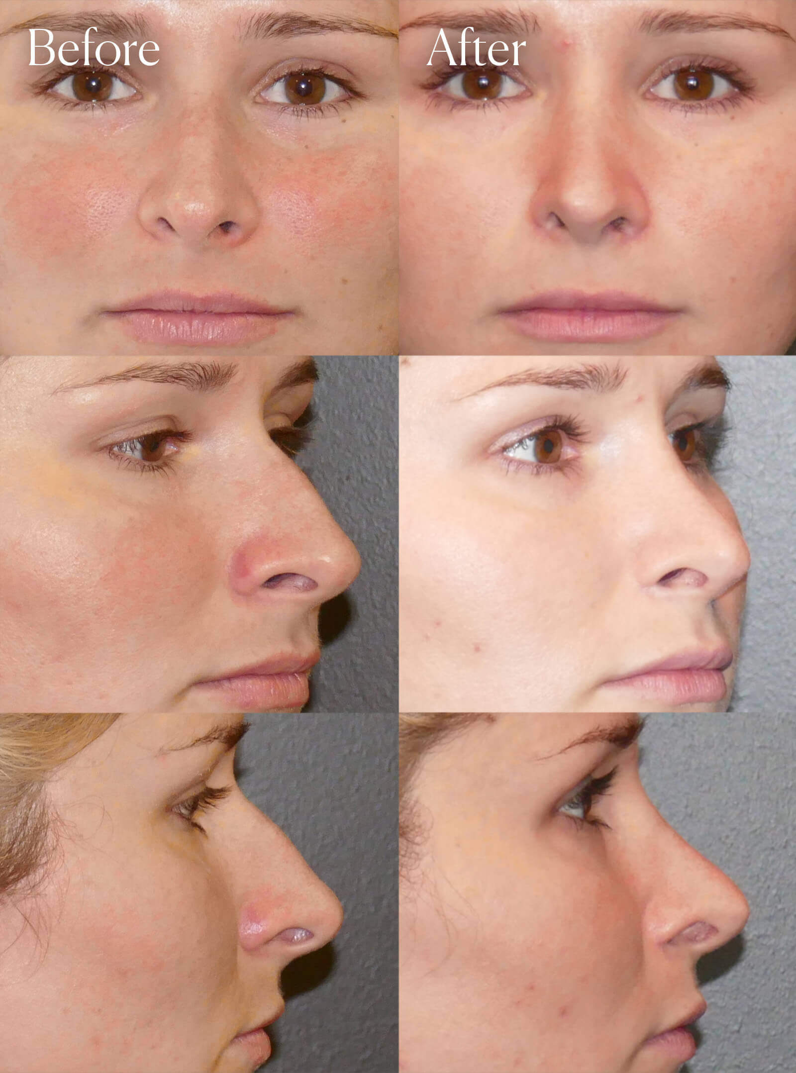 rhinoplasty plastic surgery