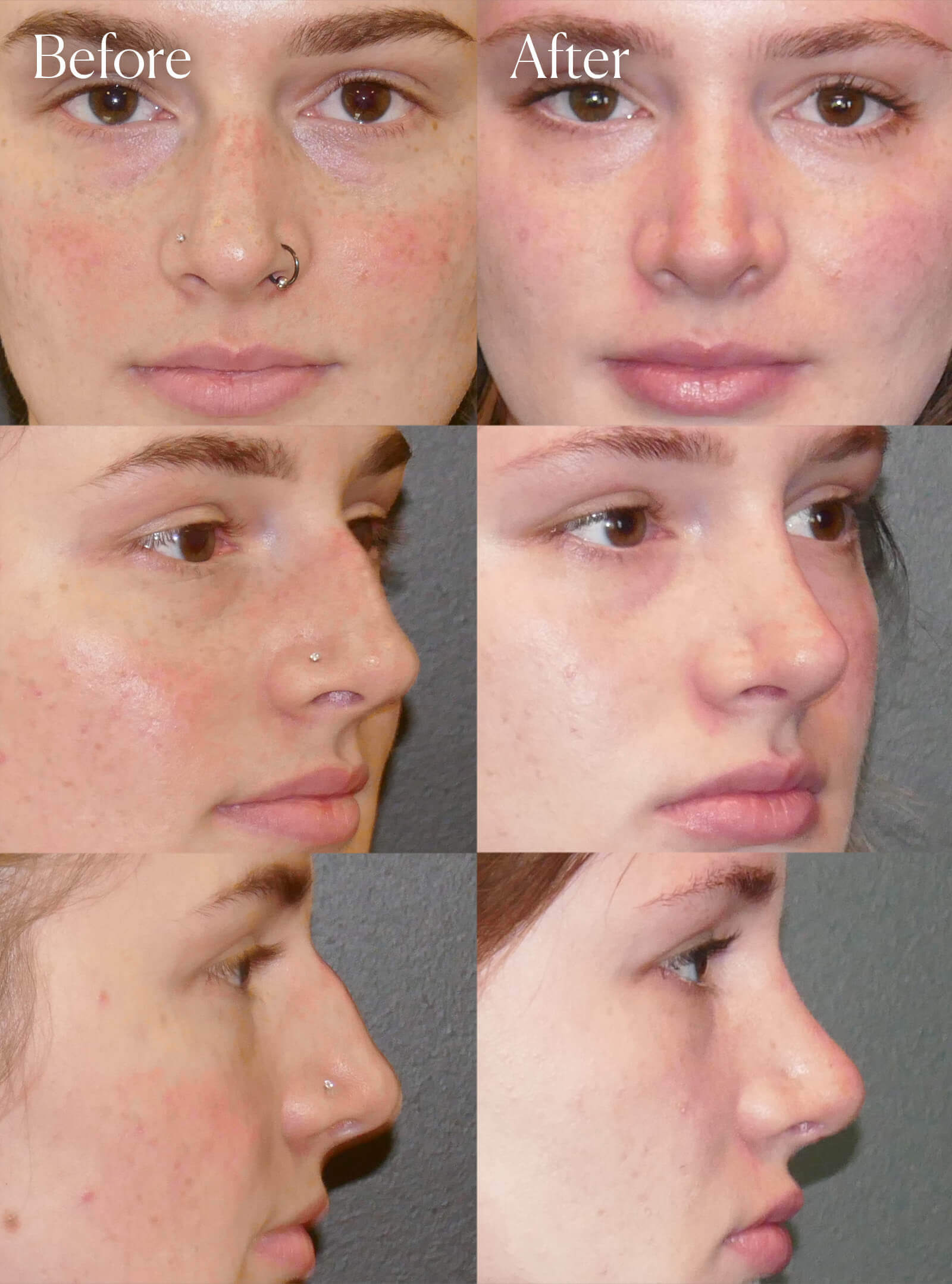 rhinoplasty procedure colorado