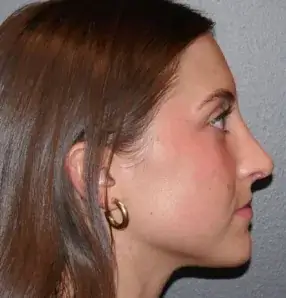 rhinoplasty after