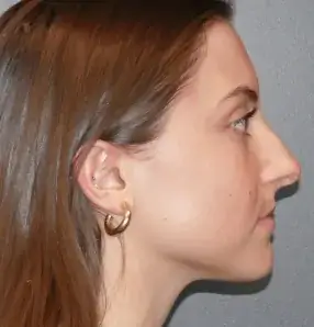 rhinoplasty before