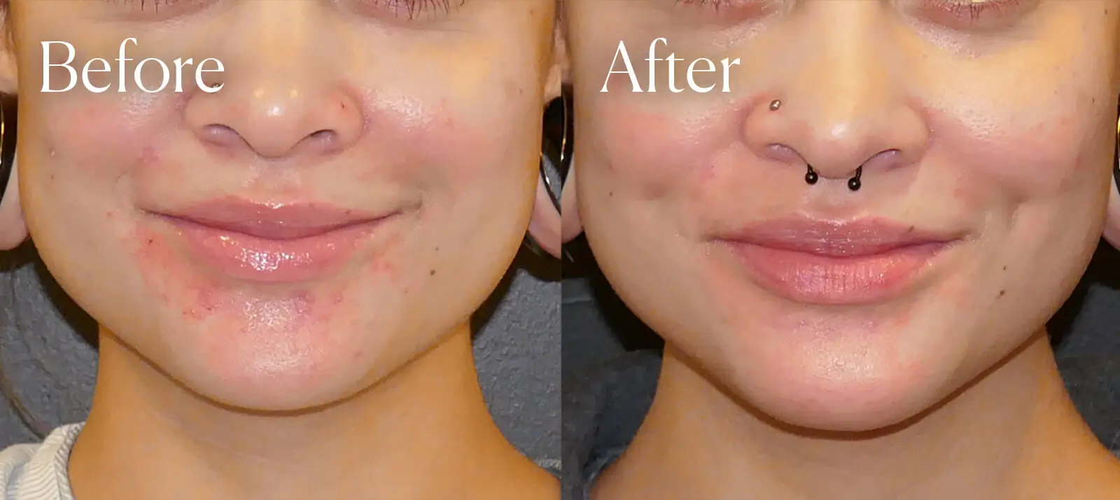 dimpleplasty facial enhancements before and after