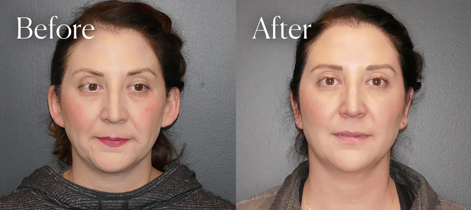 otoplasty aesthetic surgery in colorado