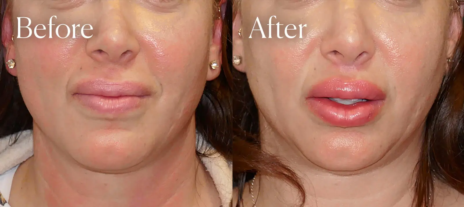 subnasal liplift aesthetic surgery before and after