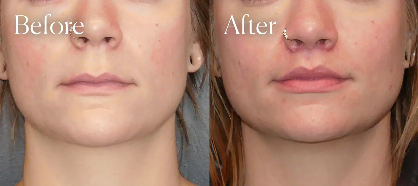 subnasal liplift plastic surgery before and after