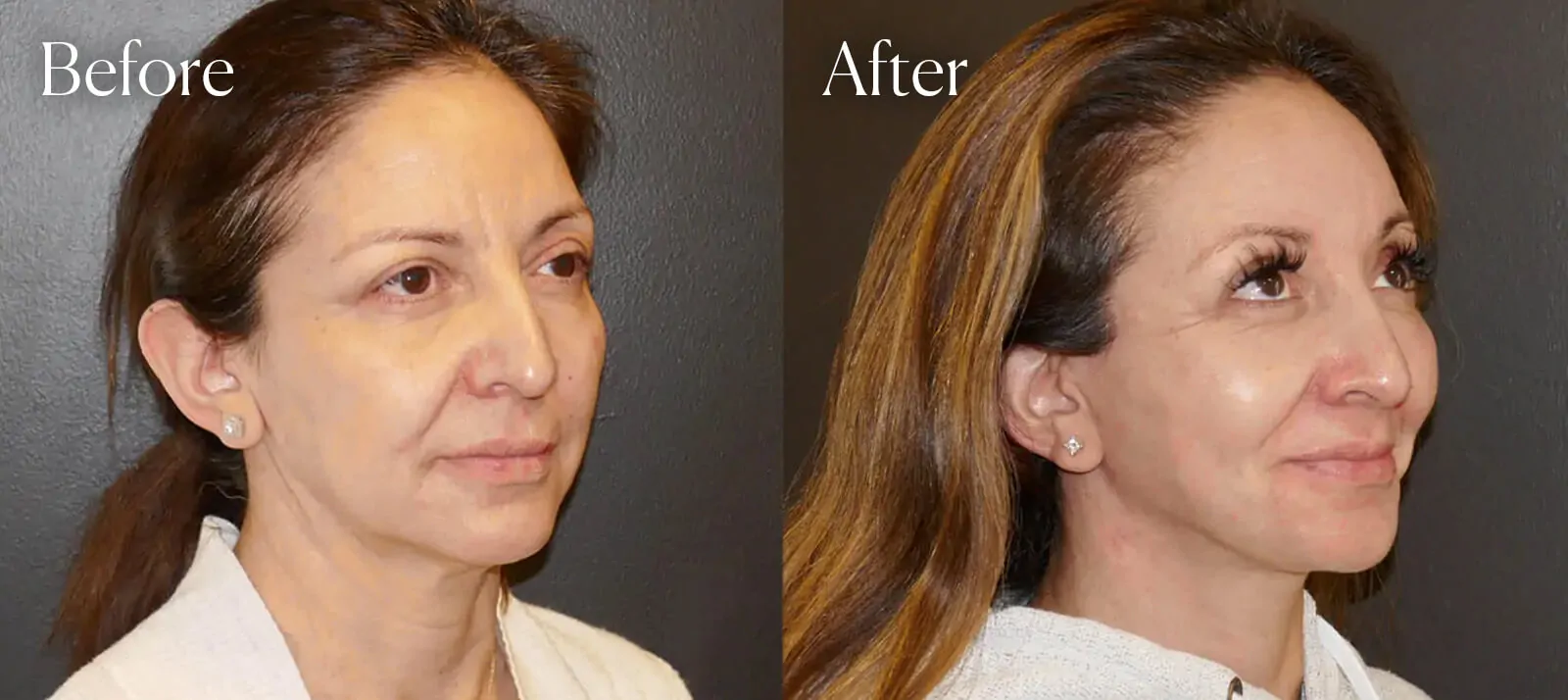 before-after-facelift-denver before after facelift denver
