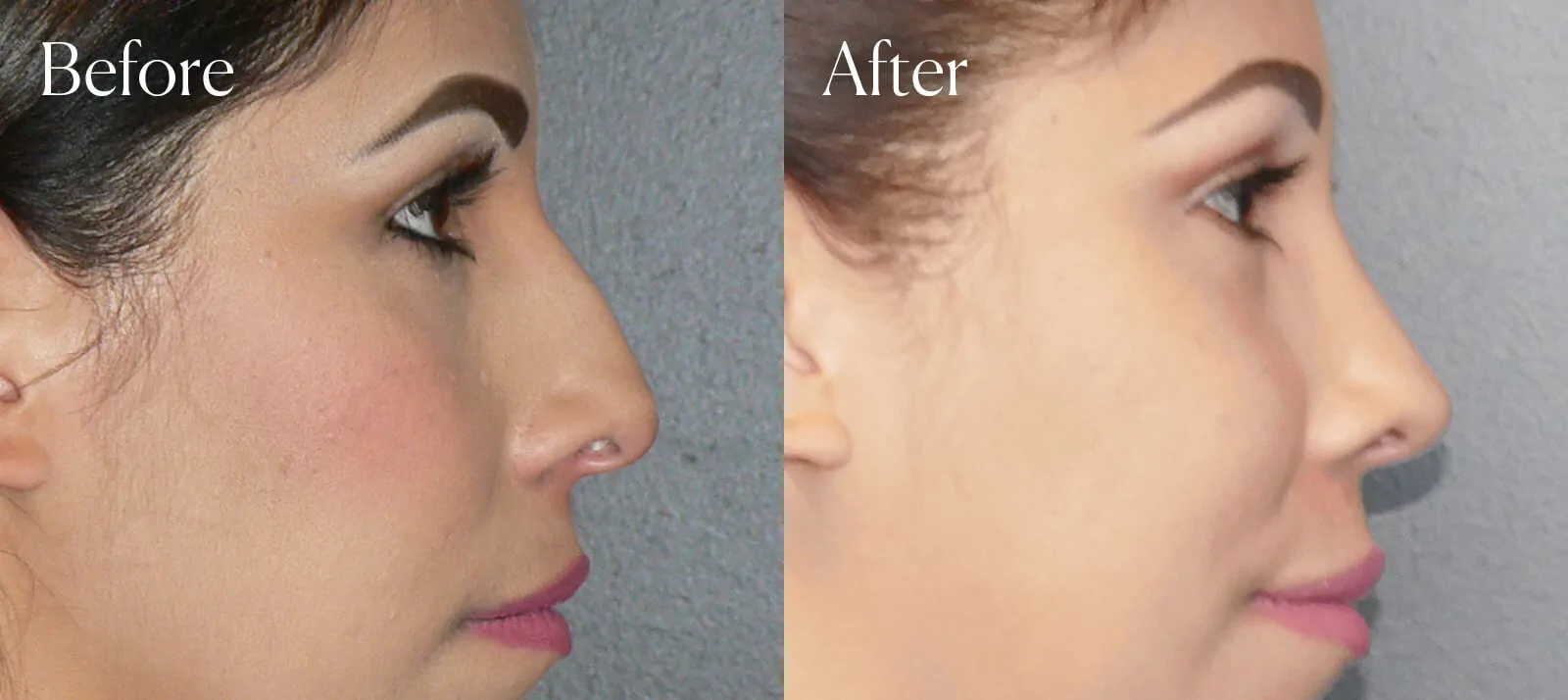 before and after ultrasonic ethnic rhinoplasty