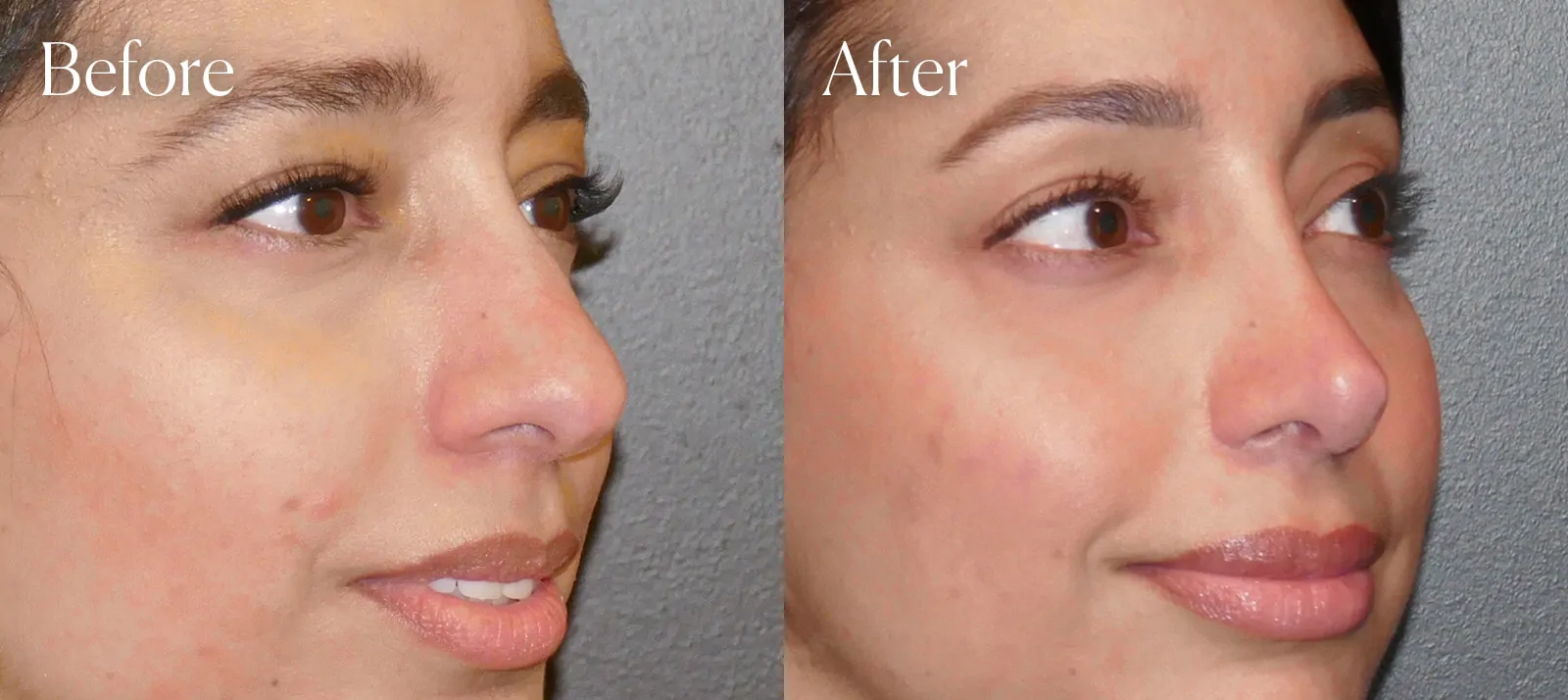 ethnic plastic surgery ultrasonic rhinoplasty