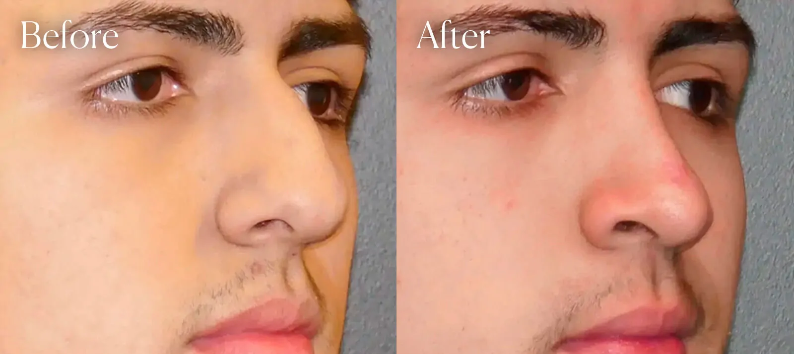 ethnic surgery results ultrasonic rhinoplasty