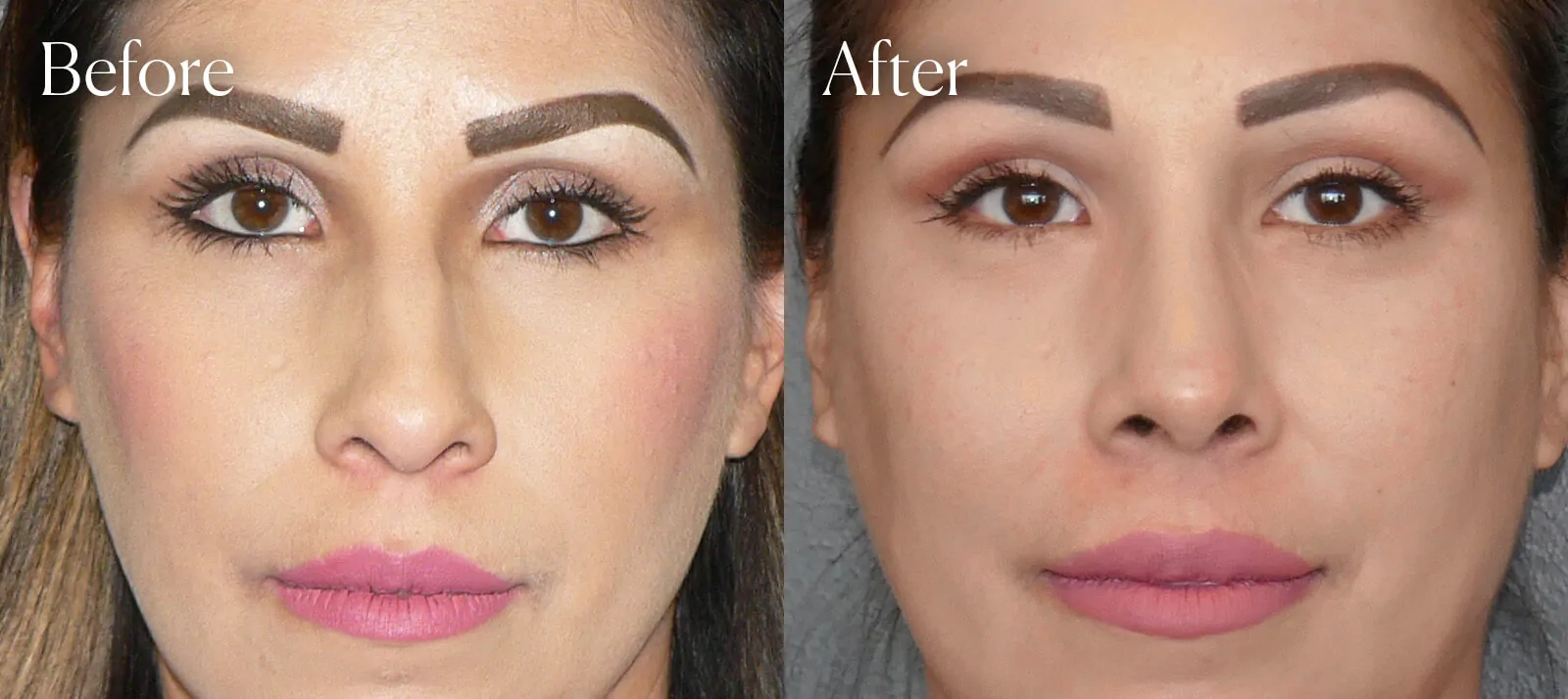 ethnic ultrasonic before and after rhinoplasty