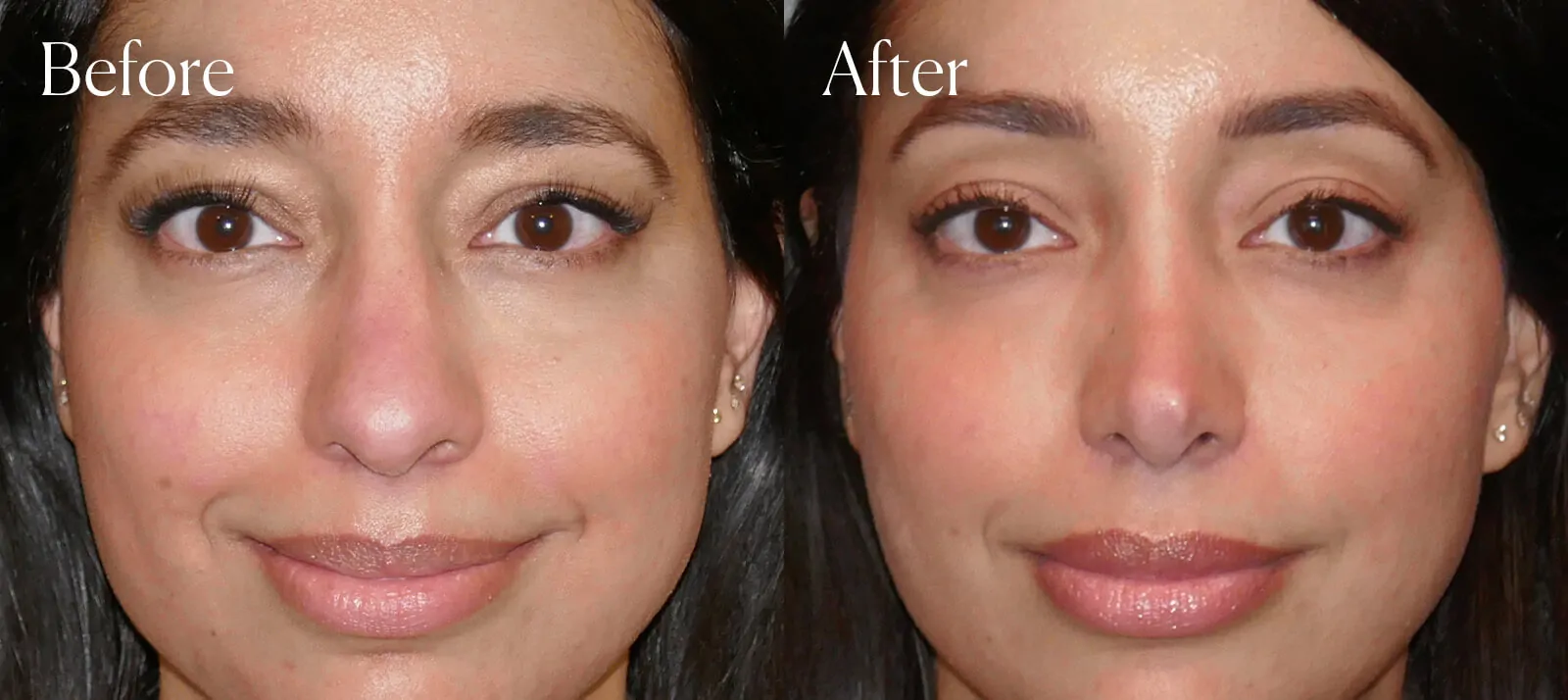 ethnic ultrasonic plastic surgery rhinoplasty