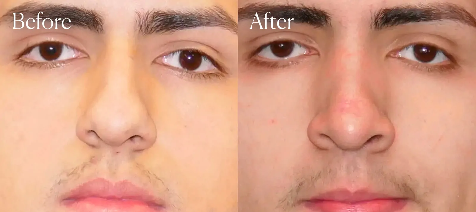 ethnic ultrasonic surgery results rhinoplasty