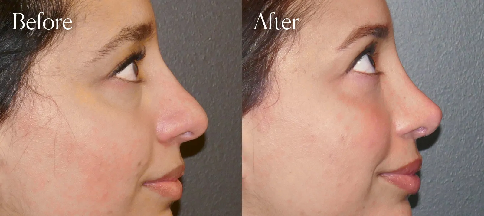 plastic surgery ethnic ultrasonic rhinoplasty