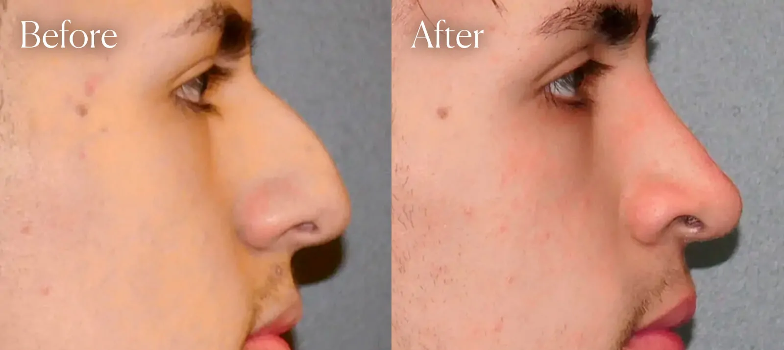 surgery results ethnic ultrasonic rhinoplasty
