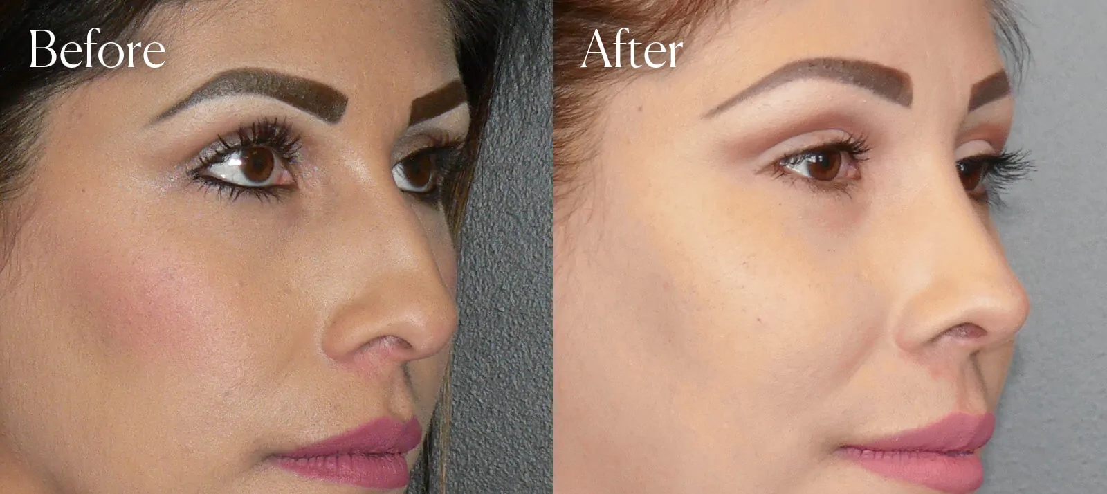 ultrasonic before and after ethnic rhinoplasty