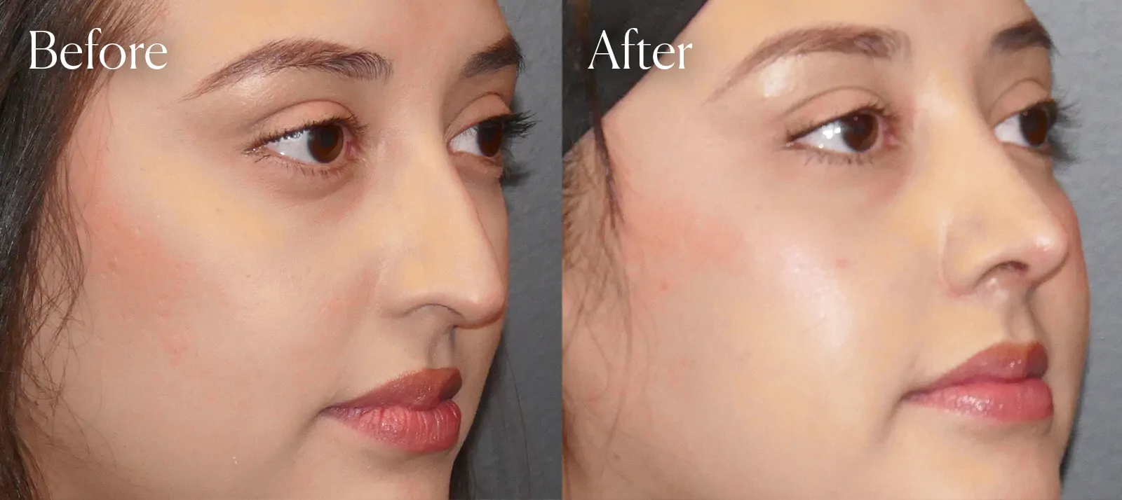 neck-liposuction-tip-rhinoplasty neck liposuction tip rhinoplasty