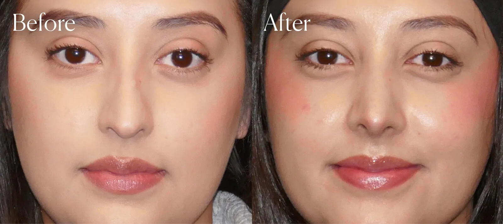 rhinoplasty-tip-neck-liposuction rhinoplasty tip neck liposuction