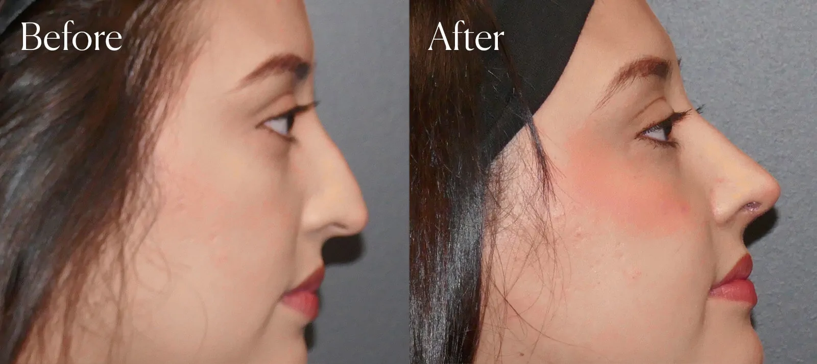 tip-rhinoplasty-neck-liposuction tip rhinoplasty neck liposuction